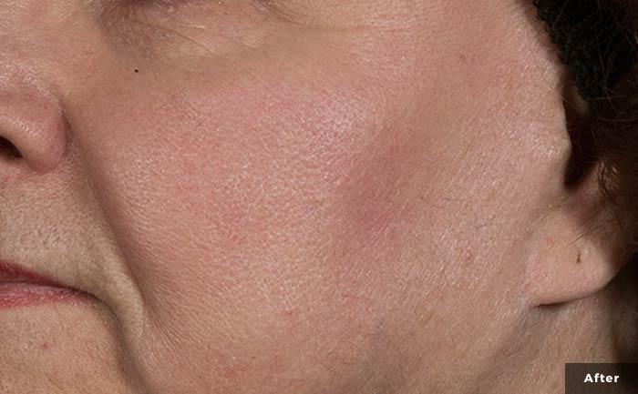 excelvplus-vascular-lesions-face-Stankiewicz-P2-post3tx
