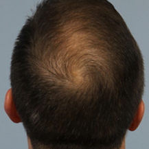 prp-hair-loss-after