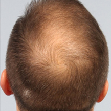 prp-hair-loss-before