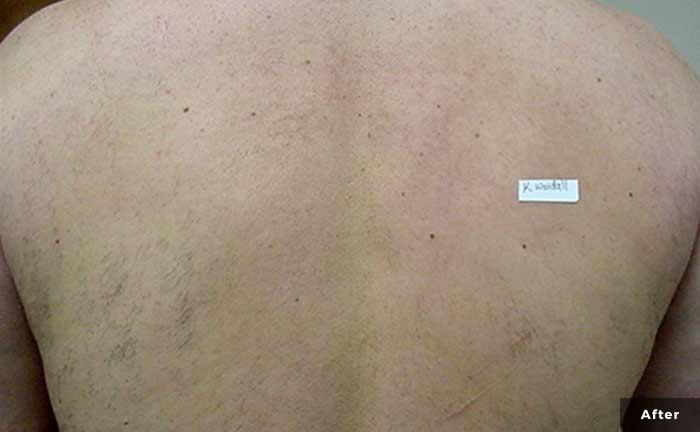xeo-hair-removal-back-area-John-Kayal-MD-P1-after-1tx