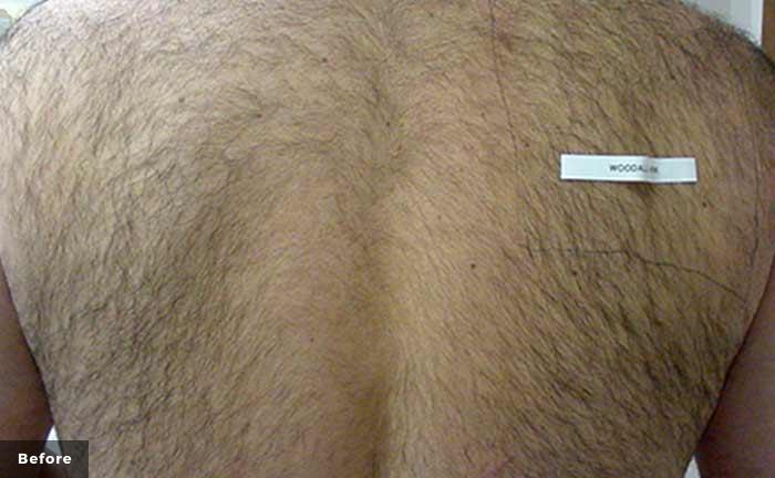 xeo-hair-removal-back-area-John-Kayal-MD-P1-before