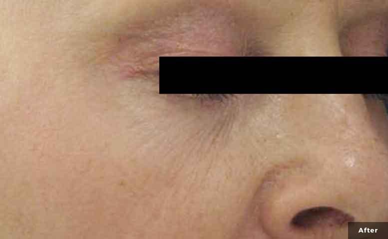 xeo-wrinkles-pearl-pearlfractional-Jill-Lezaic-MD-P1-after1Tx